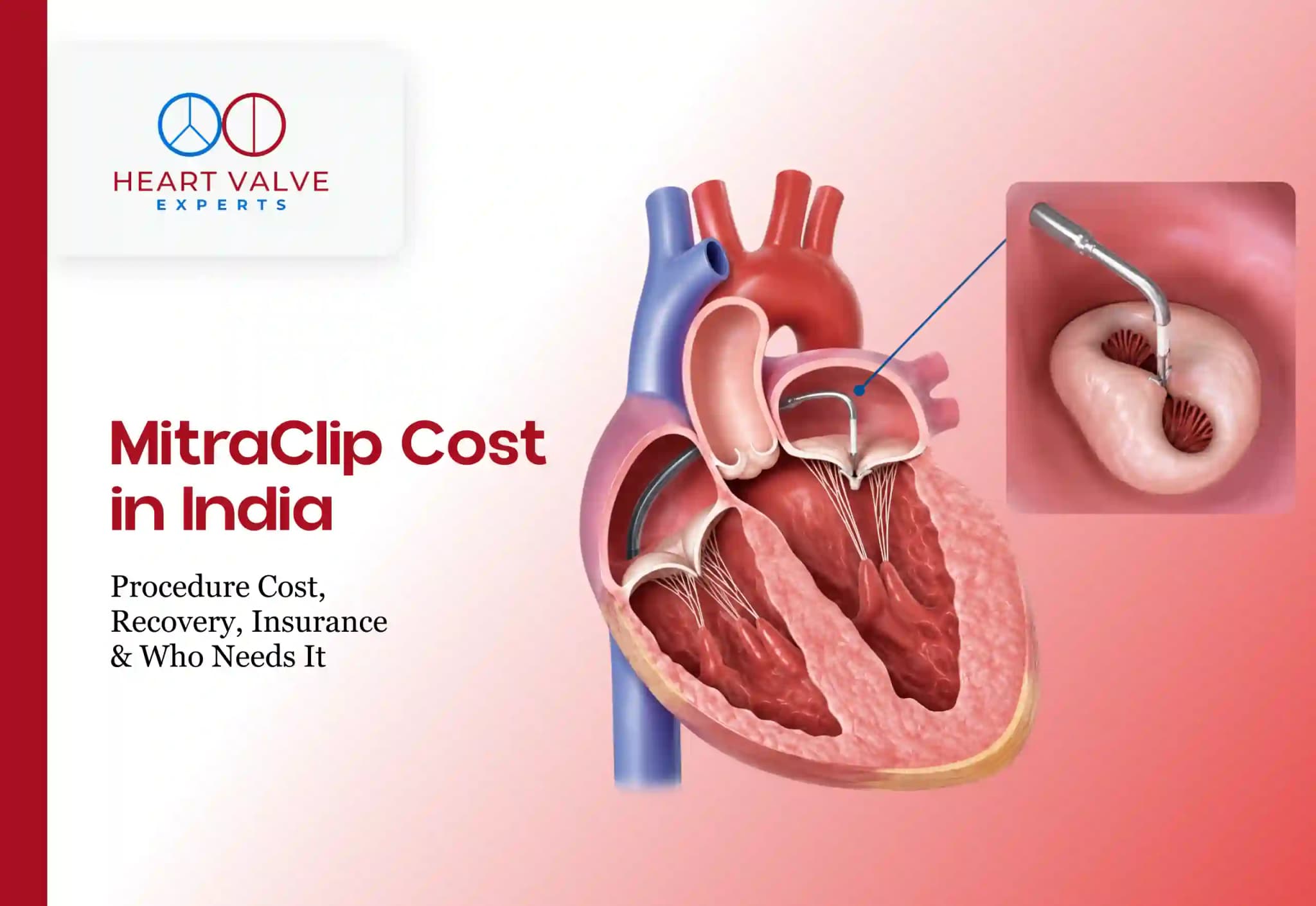 MitraClip Cost in India: Procedure Cost, Recovery, Insurance & Who Needs It